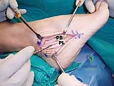 التقنيات الجراحية لإصلاح أوتار البرونيال