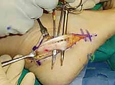 خطوات العملية الجراحية الدقيقة للكاحل