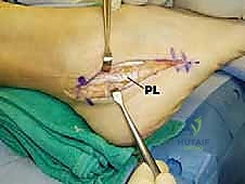 إصلاح وإعادة بناء أوتار الشظية (البرونيال): دليل شامل لمرضى الكاحل