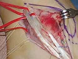 صورة توضيحية لـ انخلاع الأوتار الشظوية في الكاحل: الأسباب، الأعراض، والعلاج المتقدم مع الأستاذ الدكتور محمد هطيف