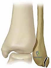 أسباب تمزق الأربطة في الكاحل