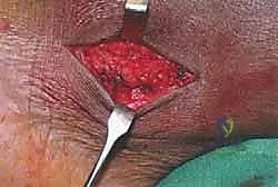 صورة توضيحية لـ انخلاع الأوتار الشظوية في الكاحل: الأسباب، الأعراض، والعلاج المتقدم مع الأستاذ الدكتور محمد هطيف