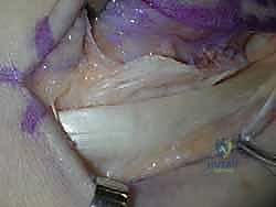 أعراض وعلامات خلع الأوتار الشظوية