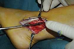 صورة توضيحية لـ انخلاع الأوتار الشظوية في الكاحل: الأسباب، الأعراض، والعلاج المتقدم مع الأستاذ الدكتور محمد هطيف