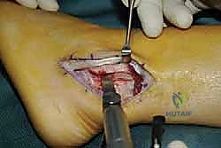 تثبيت الرباط باستخدام الخطاطيف الجراحية