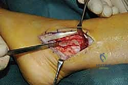 التحقق من ثبات الأوتار بعد الخياطة