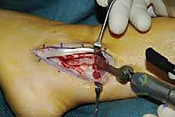 التخطيط الجراحي لعملية الكاحل