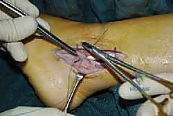 صورة توضيحية لـ انخلاع الأوتار الشظوية في الكاحل: الأسباب، الأعراض، والعلاج المتقدم مع الأستاذ الدكتور محمد هطيف