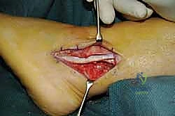 الرباط الشظوي العلوي ووظيفته