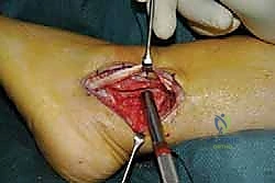 استخدام الأدوات الدقيقة في جراحة العظام