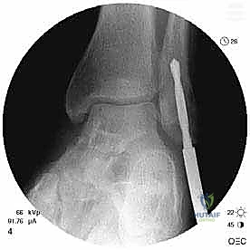 إعادة بناء الرباط الشظوي العلوي
