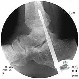 Illustration of peroneal tendon subluxation - Dr. Mohammed Hutaif