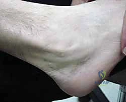 وداعاً لألم الكاحل: علاج خلع الأوتار الشظوية بتقنية تعميق الميزاب الشظوي غير المباشر في صنعاء