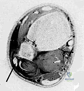 تمزق القيد الشظوي العلوي
