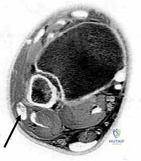 تشريح الكاحل والأوتار الشظوية