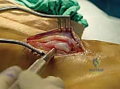 إغلاق الجرح التجميلي