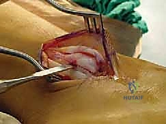 تثبيت الأربطة بالخطاطيف العظمية