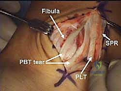 التخطيط الجراحي لتعميق الميزاب