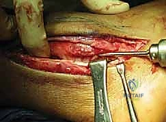 عملية تعميق الميزاب غير المباشر