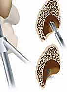 تمزق الأوتار الشظوية بسبب الإهمال