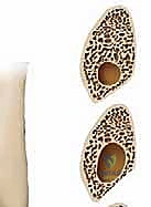 صورة توضيحية لـ وداعاً لألم الكاحل: علاج خلع الأوتار الشظوية بتقنية تعميق الميزاب الشظوي غير المباشر في صنعاء