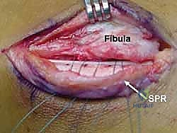 العلاج الطبيعي والتأهيل بعد الجراحة