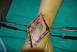 إعادة بناء وتر الظنبوب الأمامي بنقل وتر EHL علاج متقدم لقطع القدم في صنعاء مع الأستاذ الدكتور محمد هطيف