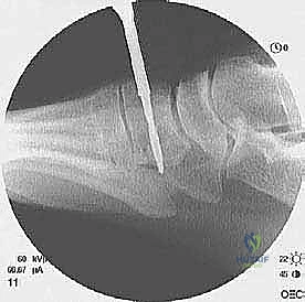 أعراض قطع القدم وتمزق وتر الظنبوب الأمامي