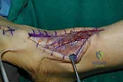 صورة توضيحية لـ إعادة بناء وتر الظنبوب الأمامي بنقل وتر EHL علاج متقدم لقطع القدم في صنعاء مع الأستاذ الدكتور محمد هطيف