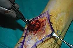 التشريح الدقيق لمنطقة الكاحل والأوتار المرتبطة بعملية نقل وتر EHL