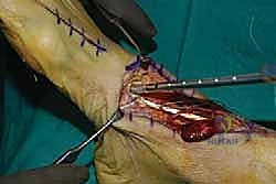 خطوات جراحة نقل وتر EHL لإصلاح قطع القدم