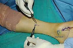 تعقيم الساق قبل الجراحة