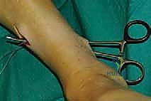 أسباب تدلي القدم الشائعة