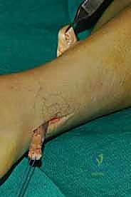 صورة طبية: نقل وتر الظنبوب الخلفي الديناميكي لعلاج تدلي القدم: استعادة الحركة والحياة الطبيعية مع الأستاذ الدكتور محمد هطيف