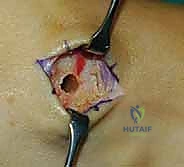 صورة توضيحية لـ نقل وتر الظنبوب الخلفي الديناميكي لعلاج تدلي القدم: استعادة الحركة والحياة الطبيعية مع الأستاذ الدكتور محمد هطيف