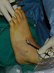 الاعتلال العصبي المحيطي