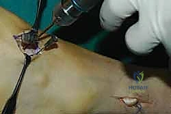 صورة طبية: نقل وتر الظنبوب الخلفي الديناميكي لعلاج تدلي القدم: استعادة الحركة والحياة الطبيعية مع الأستاذ الدكتور محمد هطيف