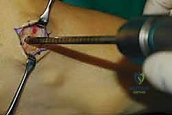 سحب وتر الظنبوب الخلفي