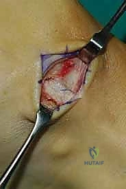 صورة توضيحية لـ نقل وتر الظنبوب الخلفي الديناميكي لعلاج تدلي القدم: استعادة الحركة والحياة الطبيعية مع الأستاذ الدكتور محمد هطيف