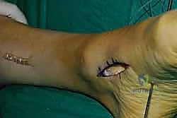 توجيه الوتر عبر الغشاء بين العظمين