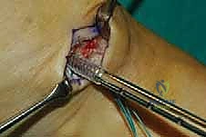 استخدام مسامير التثبيت الحيوي