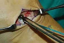 صورة طبية: نقل وتر الظنبوب الخلفي الديناميكي لعلاج تدلي القدم: استعادة الحركة والحياة الطبيعية مع الأستاذ الدكتور محمد هطيف