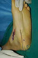 صورة طبية: نقل وتر الظنبوب الخلفي الديناميكي لعلاج تدلي القدم: استعادة الحركة والحياة الطبيعية مع الأستاذ الدكتور محمد هطيف