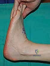 صورة طبية: نقل وتر الظنبوب الخلفي الديناميكي لعلاج تدلي القدم: استعادة الحركة والحياة الطبيعية مع الأستاذ الدكتور محمد هطيف