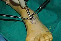 صورة طبية: نقل وتر الظنبوب الخلفي الديناميكي لعلاج تدلي القدم: استعادة الحركة والحياة الطبيعية مع الأستاذ الدكتور محمد هطيف