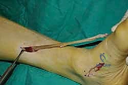 صورة طبية: نقل وتر الظنبوب الخلفي الديناميكي لعلاج تدلي القدم: استعادة الحركة والحياة الطبيعية مع الأستاذ الدكتور محمد هطيف