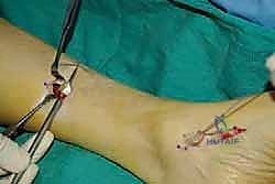 فحص المشي للمريض