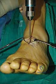 تقييم قوة العضلات