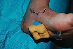 صورة طبية: نقل وتر الظنبوب الخلفي الديناميكي لعلاج تدلي القدم: استعادة الحركة والحياة الطبيعية مع الأستاذ الدكتور محمد هطيف