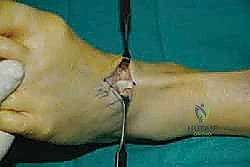 صورة طبية: نقل وتر الظنبوب الخلفي الديناميكي لعلاج تدلي القدم: استعادة الحركة والحياة الطبيعية مع الأستاذ الدكتور محمد هطيف